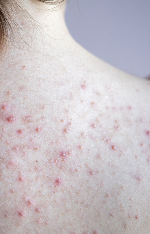 Binsina Laser Clinic - Back Acne