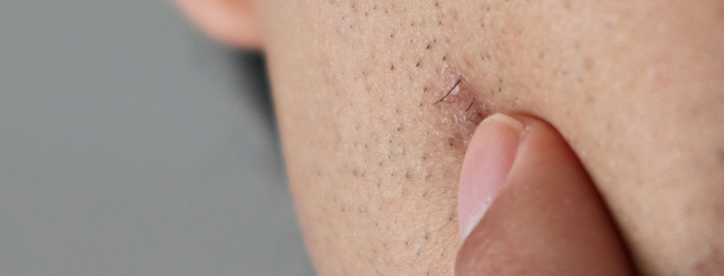 Binsina Laser Clinic - Ingrown Hair Treatment