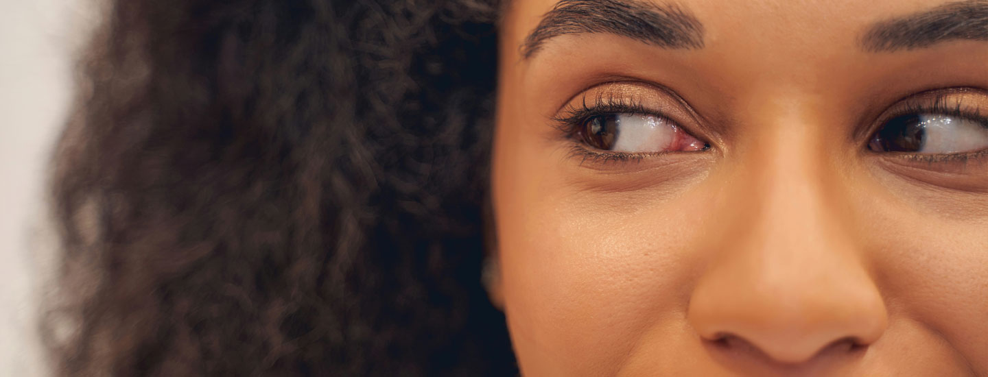 Binsina Laser Clinic - Laser Genesis