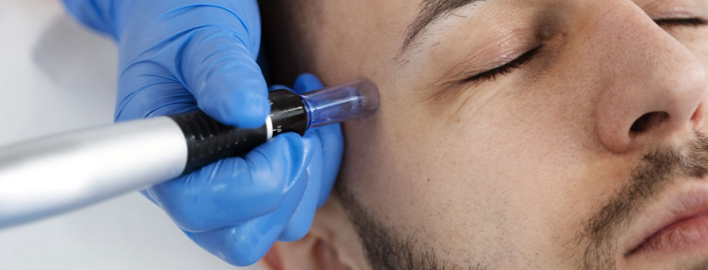 Binsina Laser Clinic - Microneedling