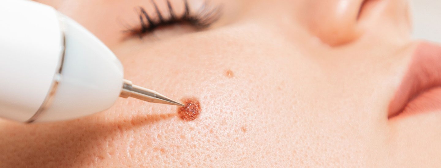 Binsina Laser Clinic - Mole Removal