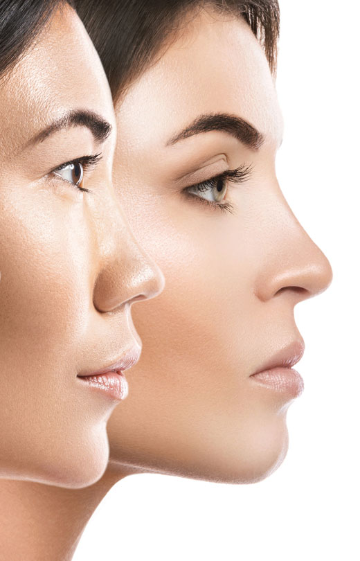Binsina Laser Clinic - Plasma Therapy (face)
