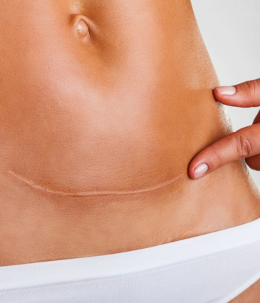 Binsina Laser Clinic - Scar treatment