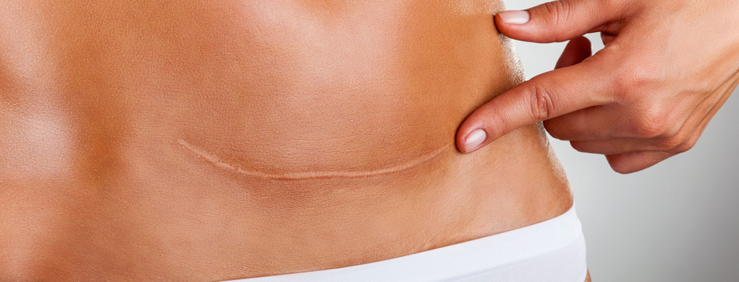 Binsina Laser Clinic - Scar treatment