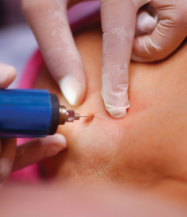 Binsina Laser Clinic - Skin Tag Removal