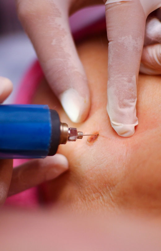 Binsina Laser Clinic - Skin Tag Removal