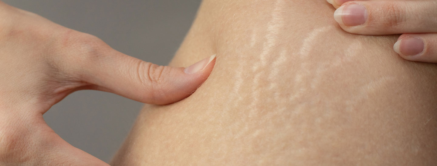 Binsina Laser Clinic - Stretch Marks