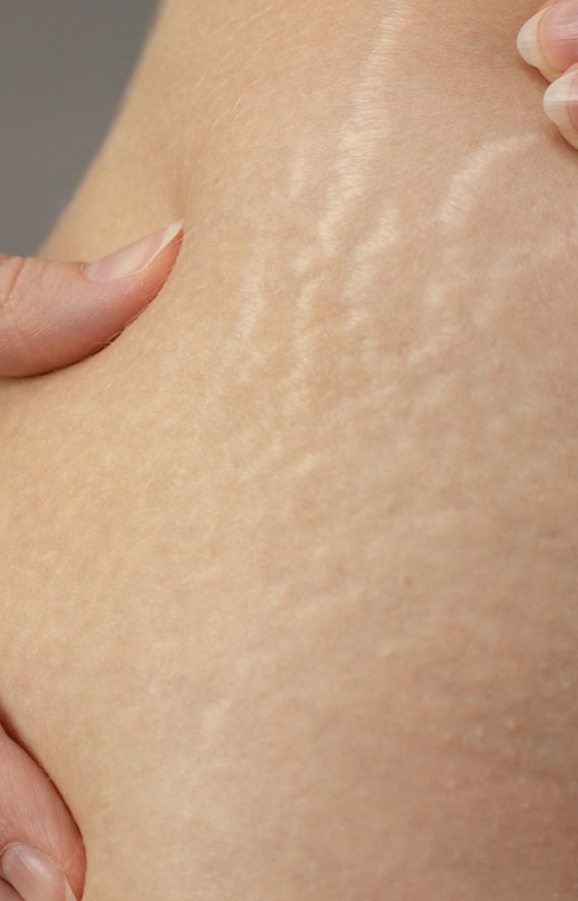 Binsina Laser Clinic - Stretch Marks