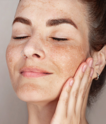 Binsina Skin & Laser Clinic - Age Spots