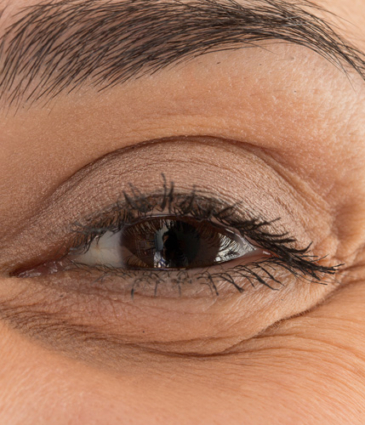 Binsina Skin & Laser Clinic - Crow’s Feet 2