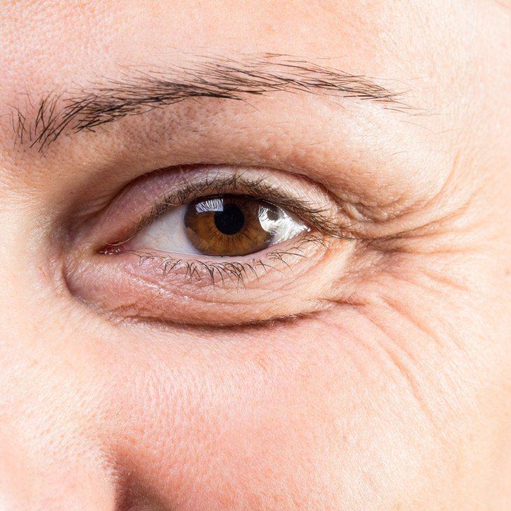 Binsina Skin & Laser Clinic - Crow’s Feet 3