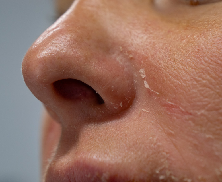 Binsina Skin & Laser Clinic - Eczema