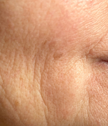 Binsina Skin & Laser Clinic - Fine Lines & Wrinkles