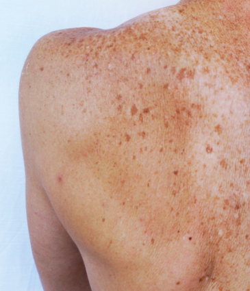 Binsina Skin & Laser Clinic - Hyperpigmentation 2