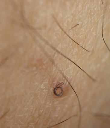 Binsina Skin & Laser Clinic - Ingrown Hair 2