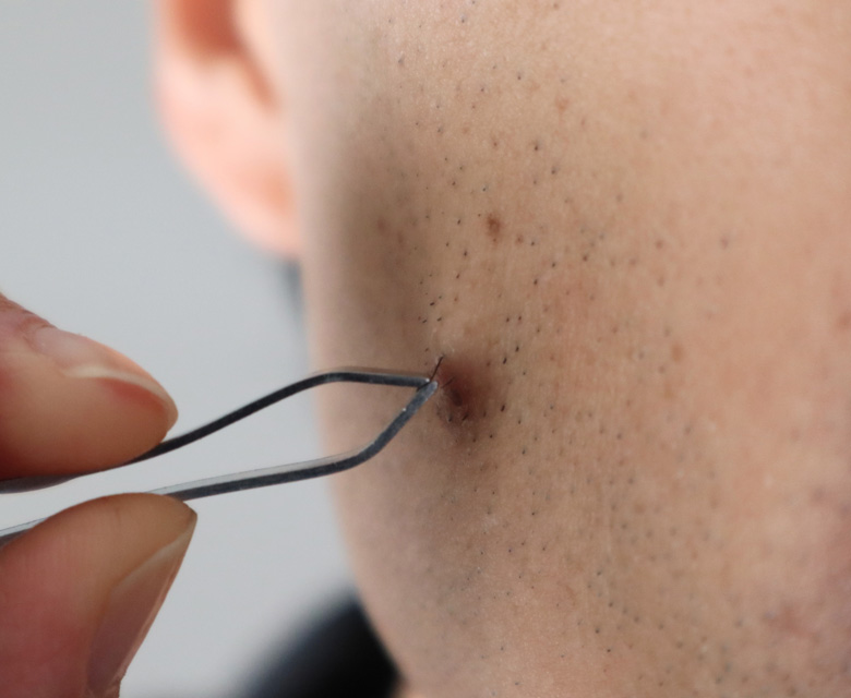 Binsina Skin & Laser Clinic - Ingrown Hair