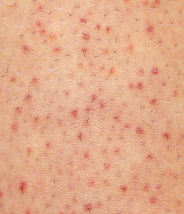 Binsina Skin & Laser Clinic - Keratosis Pilaris 2
