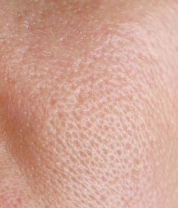 Binsina Skin & Laser Clinic - Large Pores 2