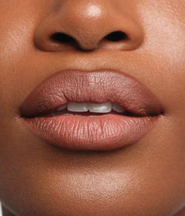 Binsina Skin & Laser Clinic - Lip Fillers 4