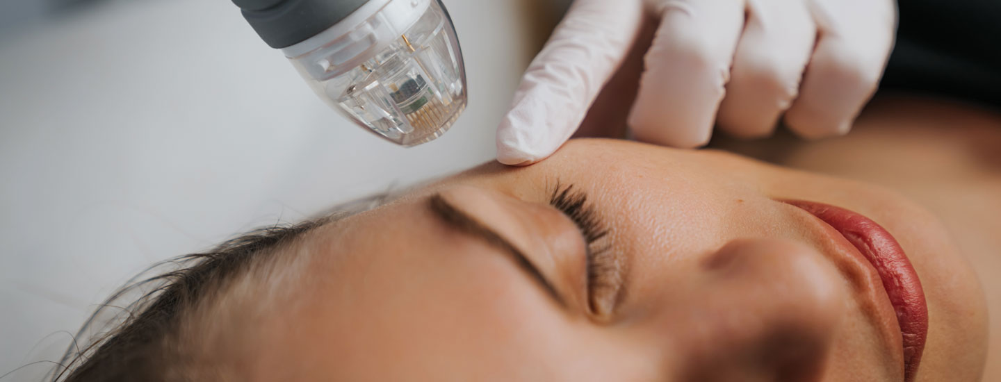 Binsina Skin & Laser Clinic - Microneedling