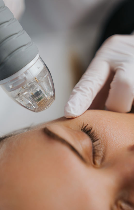 Binsina Skin & Laser Clinic - Microneedling