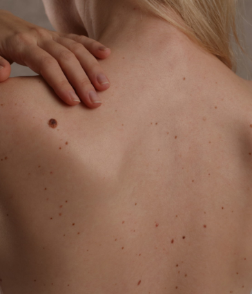 Binsina Skin & Laser Clinic - Moles