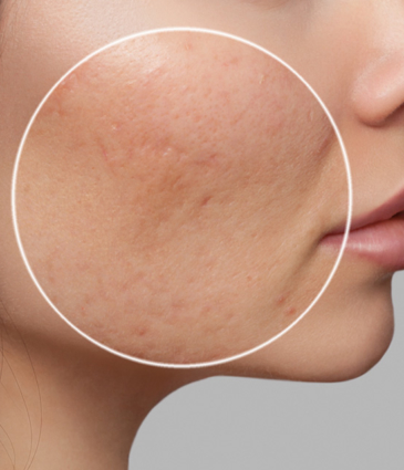 Binsina Skin & Laser Clinic - Post Inflammatory Hyperpigmentation