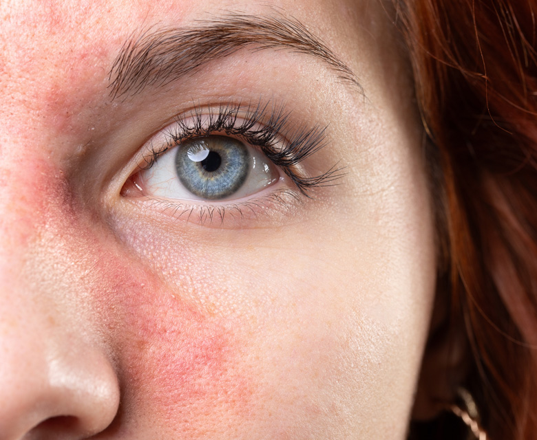 Binsina Skin & Laser Clinic - Rosacea