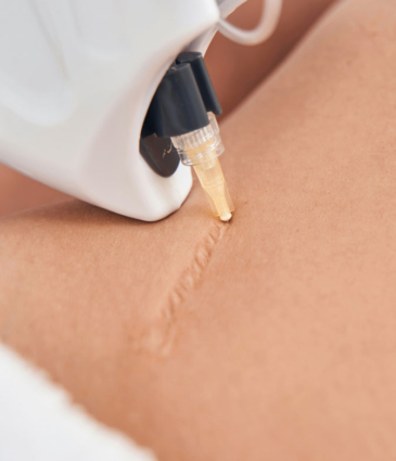 Binsina Skin & Laser Clinic - Scar treatment