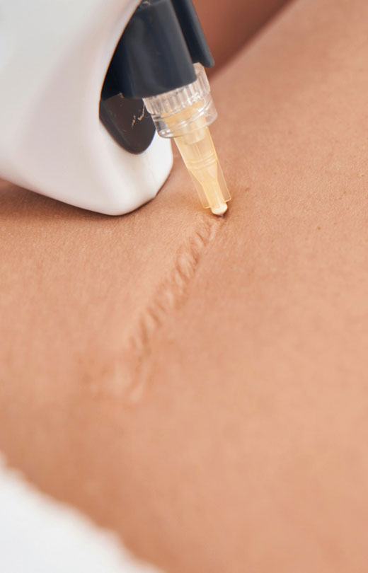 Binsina Skin & Laser Clinic - Scar treatment