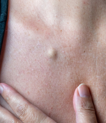 Binsina Skin & Laser Clinic - Sebaceous Cyst