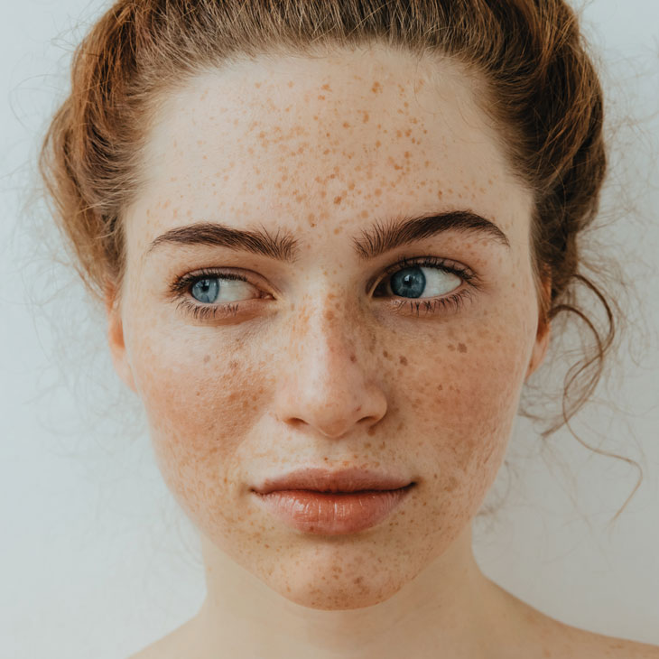 Binsina Skin & Laser Clinic - Skin Blemish Removal 2