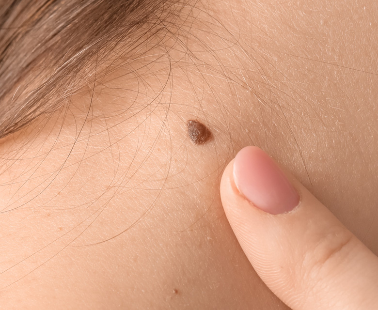 Binsina Skin & Laser Clinic - Skin Tags