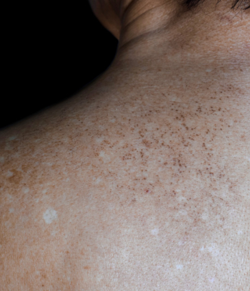 Binsina Skin & Laser Clinic - Solar Lentigimes