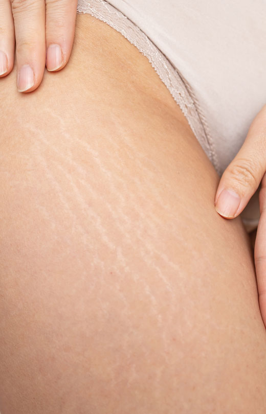 Binsina Skin & Laser Clinic - Stretch Marks