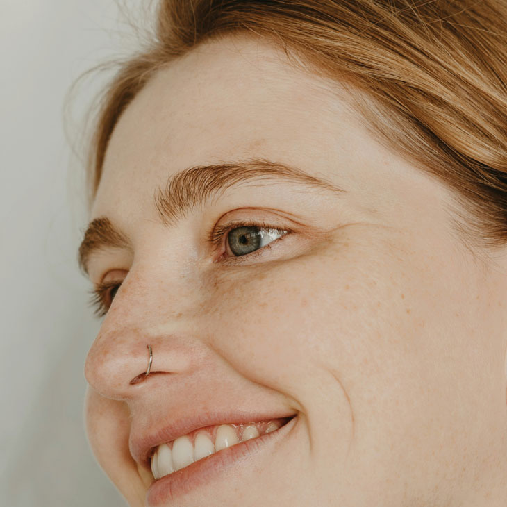 Binsina Skin & Laser Clinic - Sun Damage - Pigmentation 2
