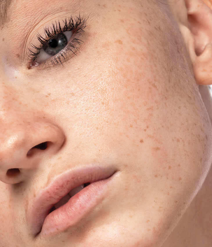 Binsina Skin & Laser Clinic - Sun Damage - Pigmentation 3