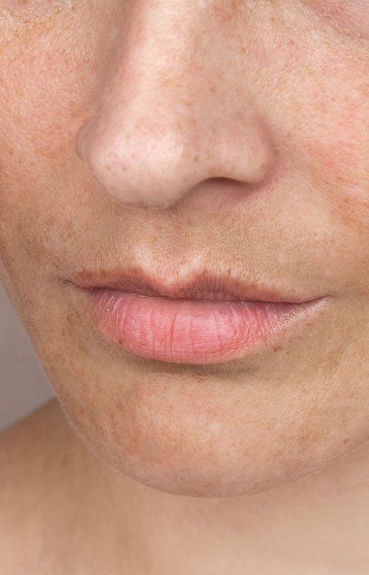 Binsina Skin & Laser Clinic - Sun Damage - Pigmentation