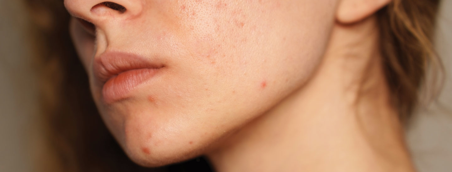 Binsina Skin & Laser Clinic - Conditions